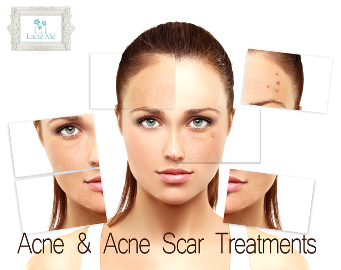 Acne & Acne Scar Treatments – Lucie Me Medical Spa