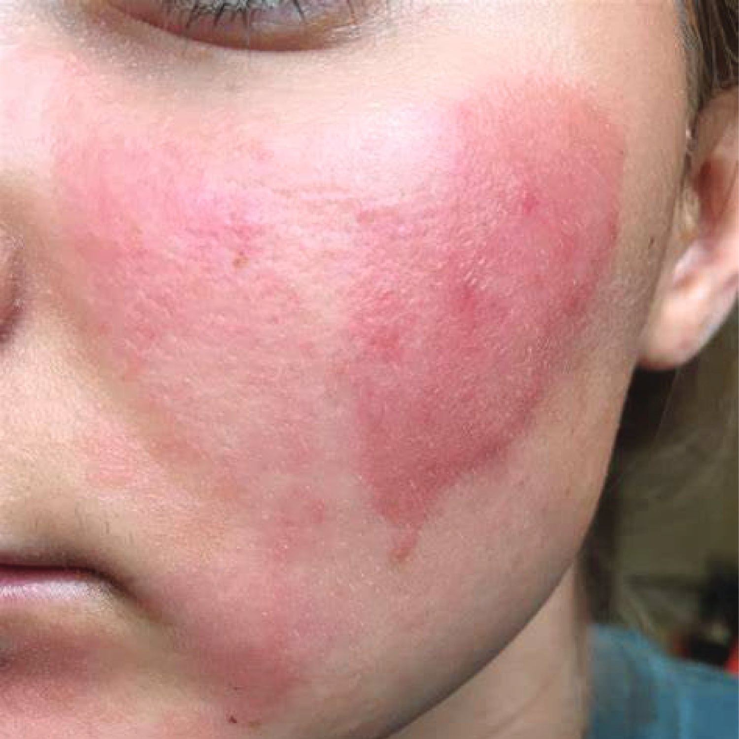 Burn Marks Lucie Me Medical Spa