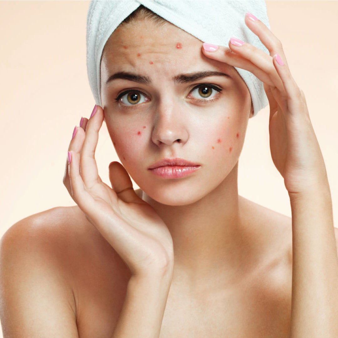 Acne Treatment