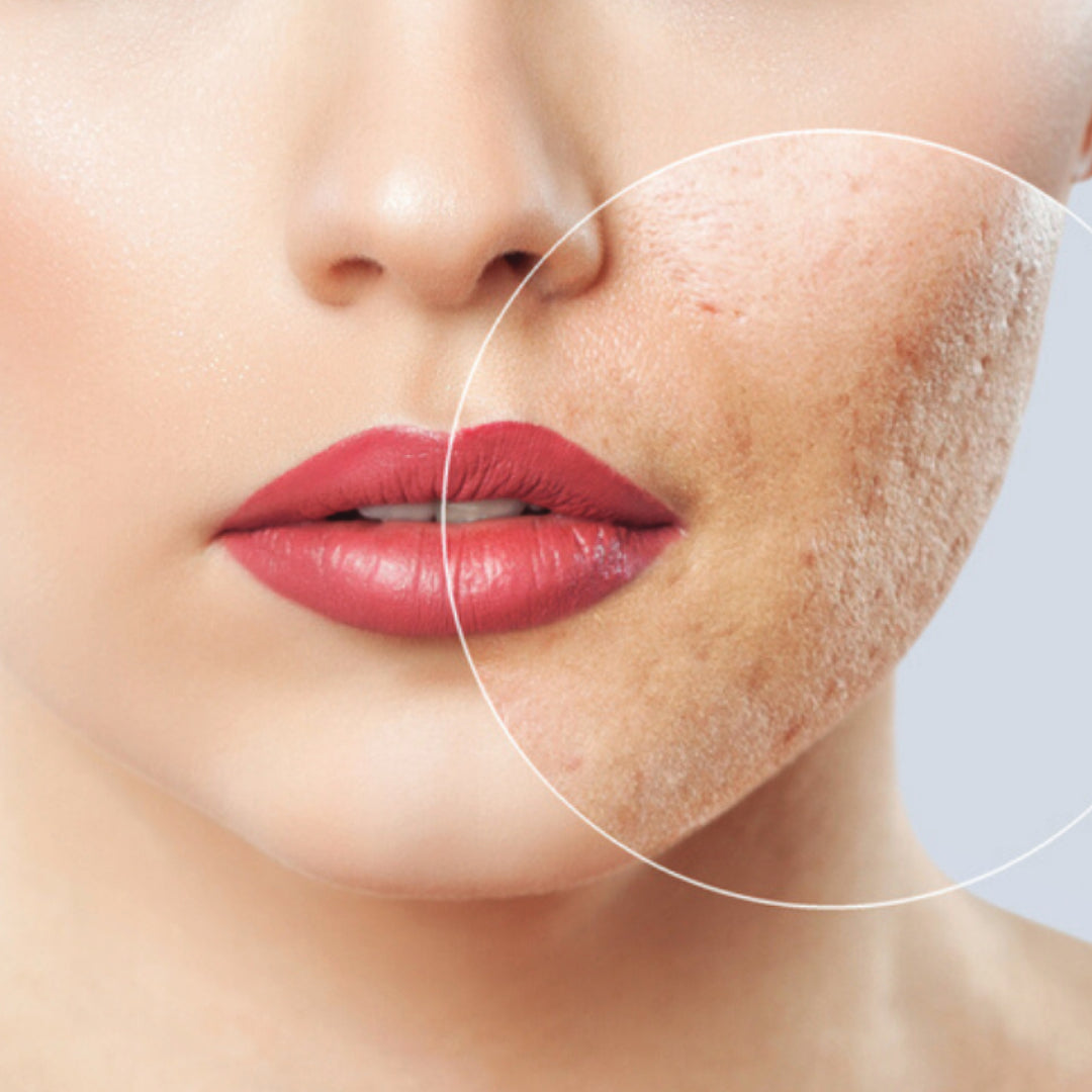 Acne Scar Treatment