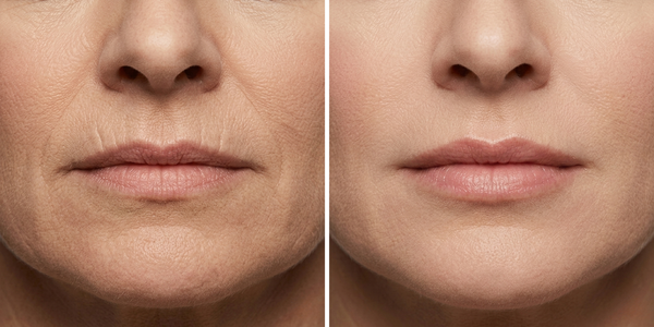 Lip lines