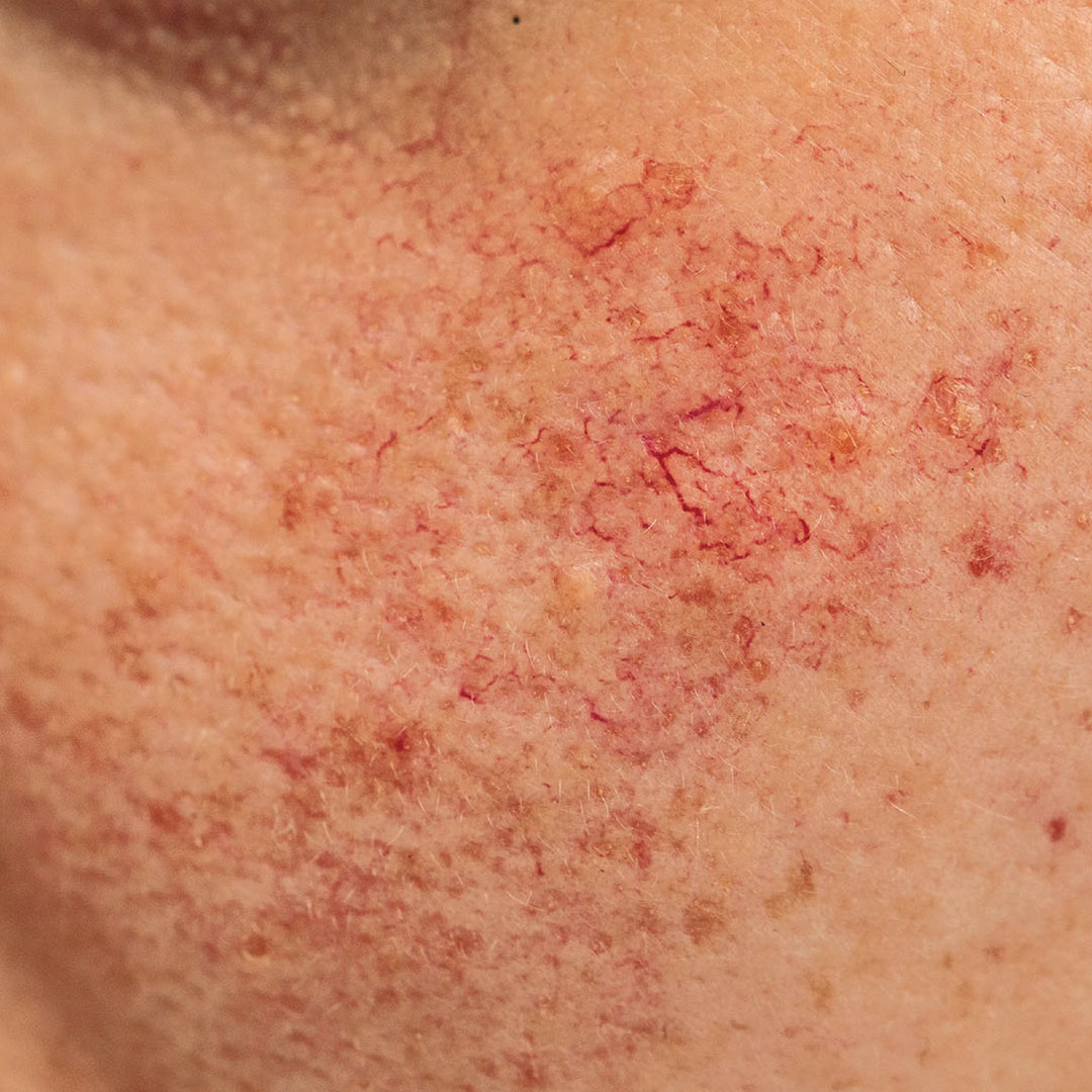 Broken Capillaries