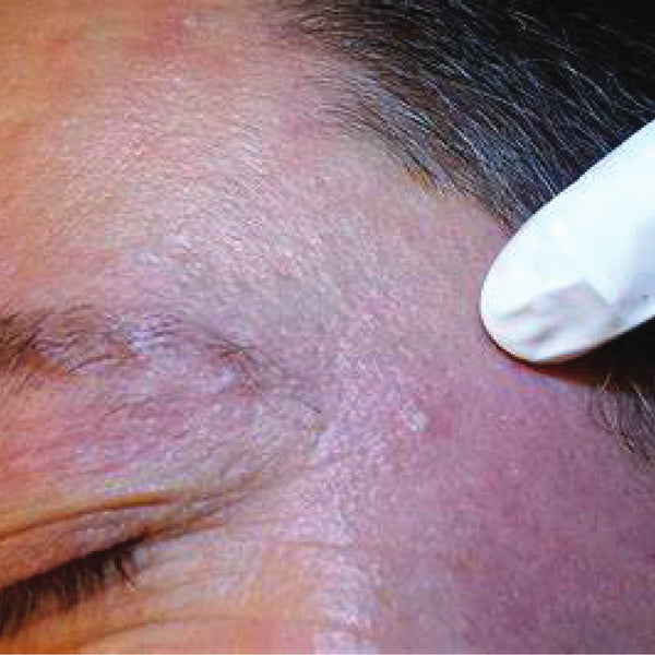 Cholesterol deposits and other minor benign lesions