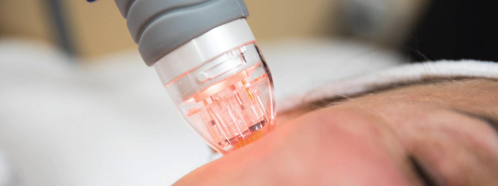 Intensif RF Microneedling in Toronto