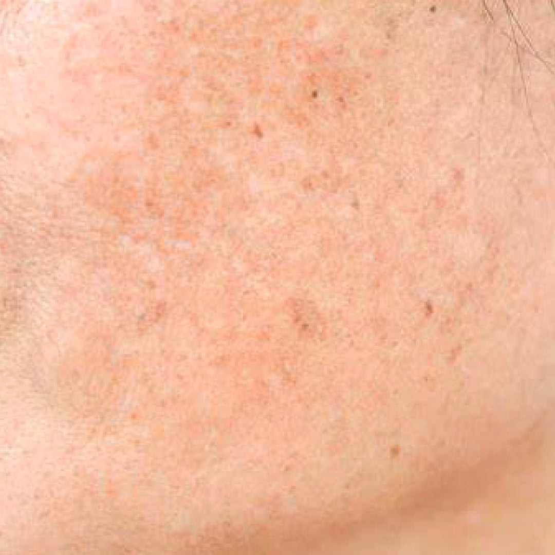 Melasma