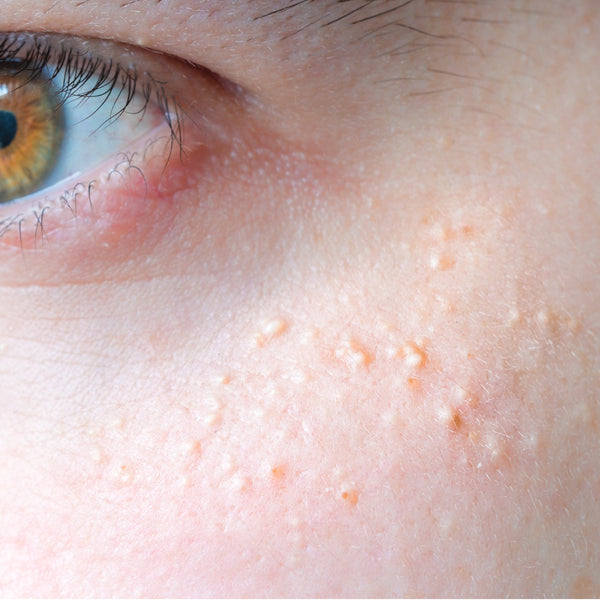 Milia (small white cysts)