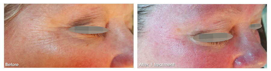 Before and after results