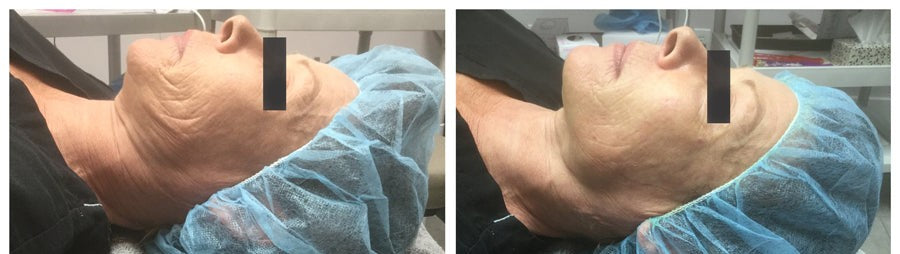 In-clinic result