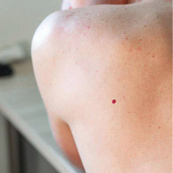 Cherry angiomas and ruby points