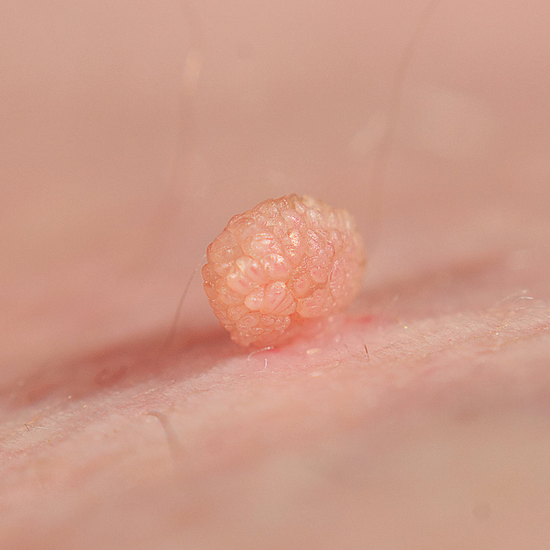 Skin Tag Removal