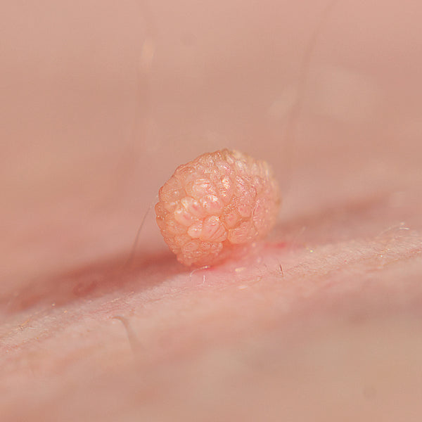 Skin tags (fibroma pendulum)