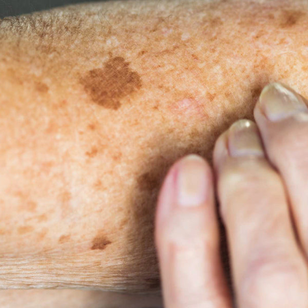 Sun spots and age spots (solar lentigo)