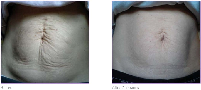 Abdomen