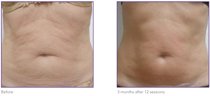 Abdomen · 12 weeks