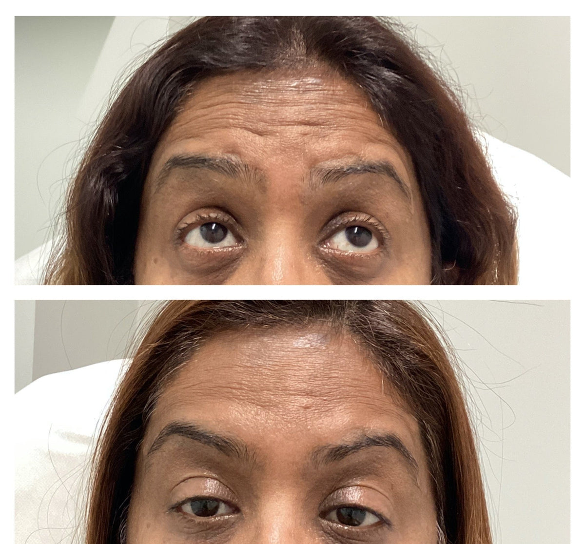 Forehead lines