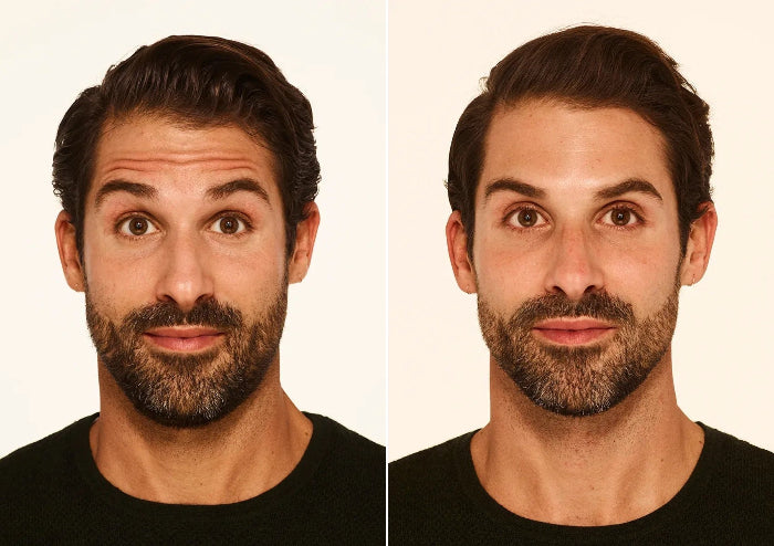 Forehead lines (men)
