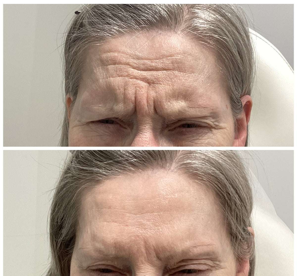 Forehead lines