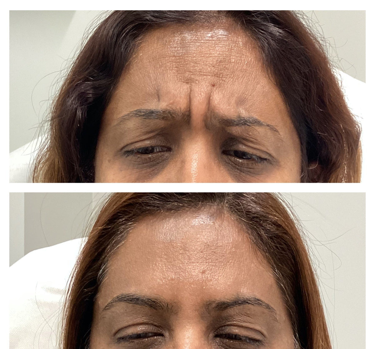 Glabella / Frown Lines