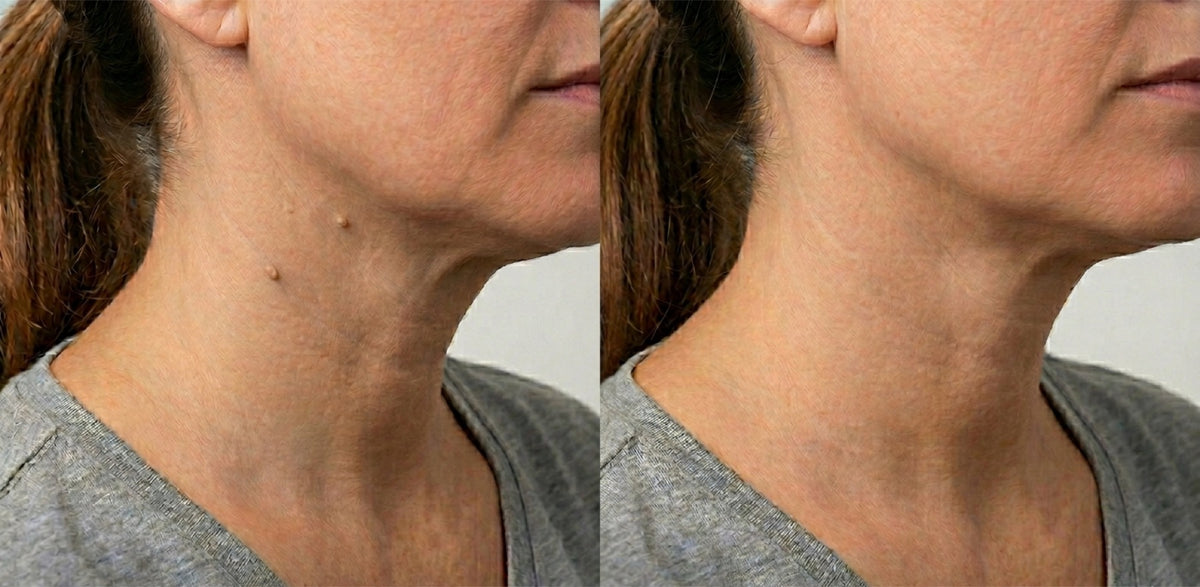 Neck Skin Tags