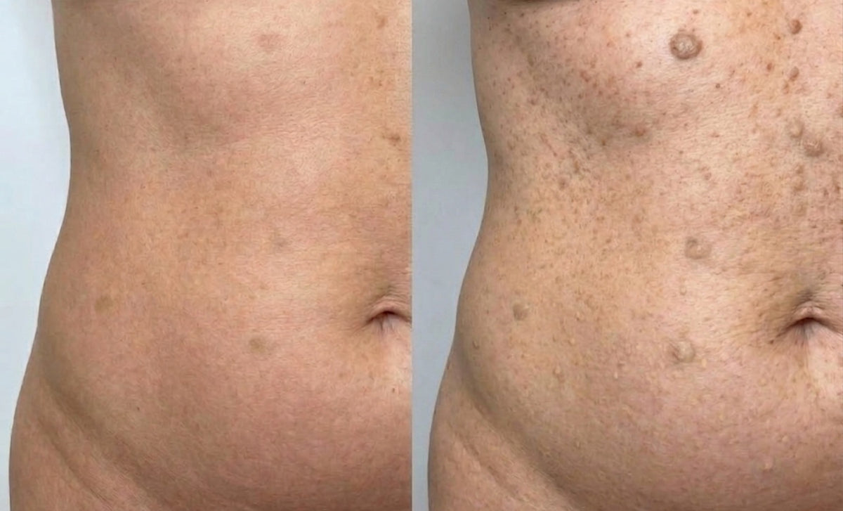 Abdomen Skin Tags