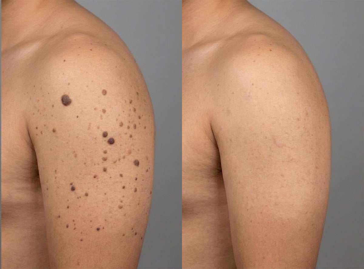 Arm Skin Tags