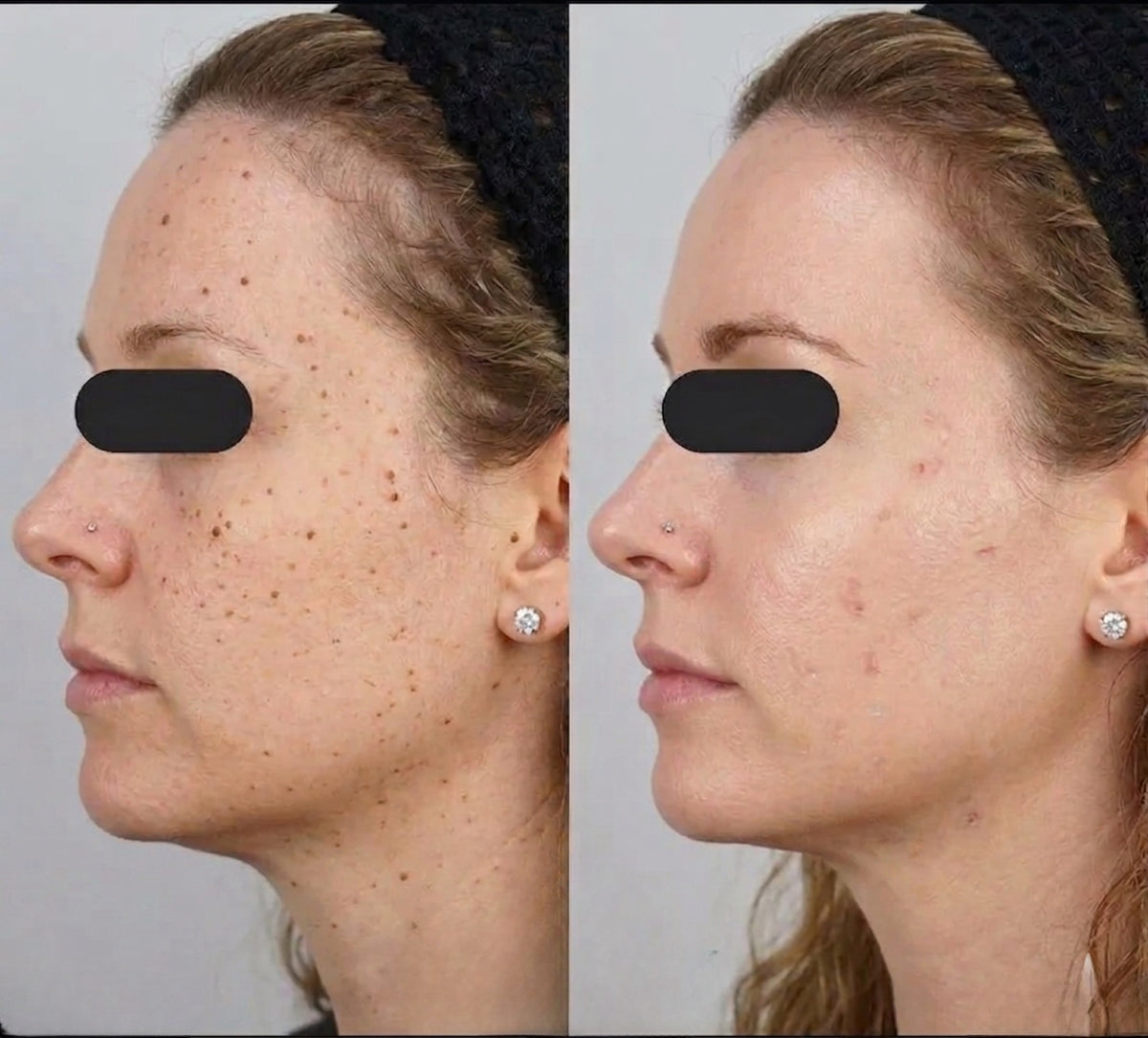 Face Skin Tags