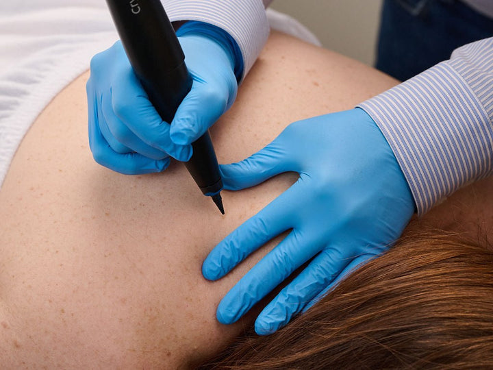 Skin Tag Removal
