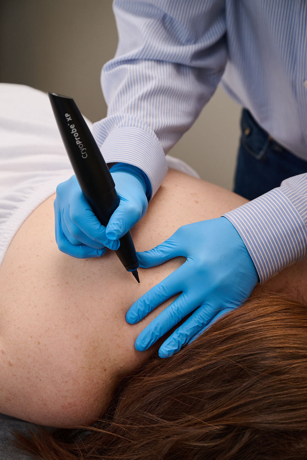 Skin Tag Removal in Toronto