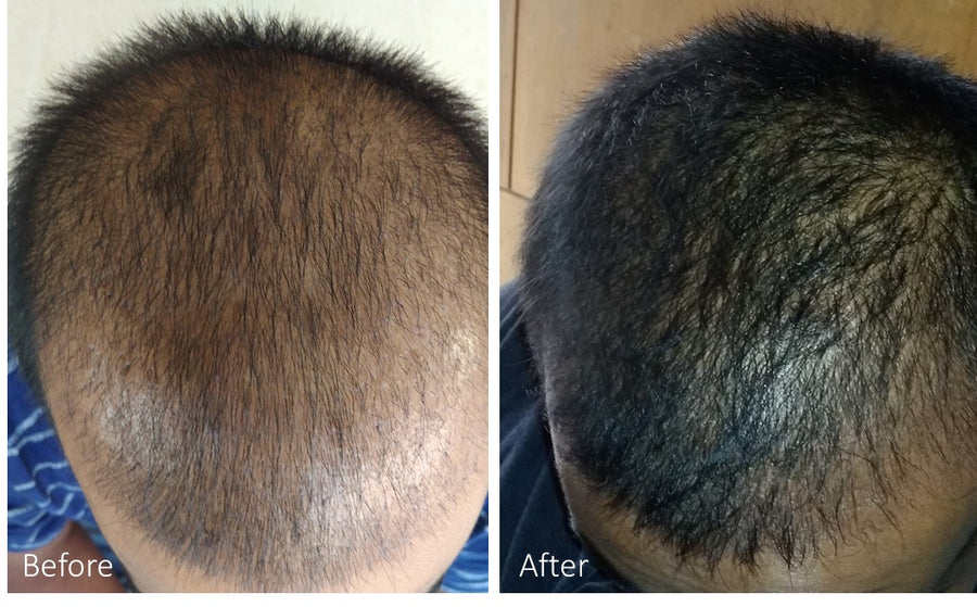 Scalp microneedling with the eDermaStamp