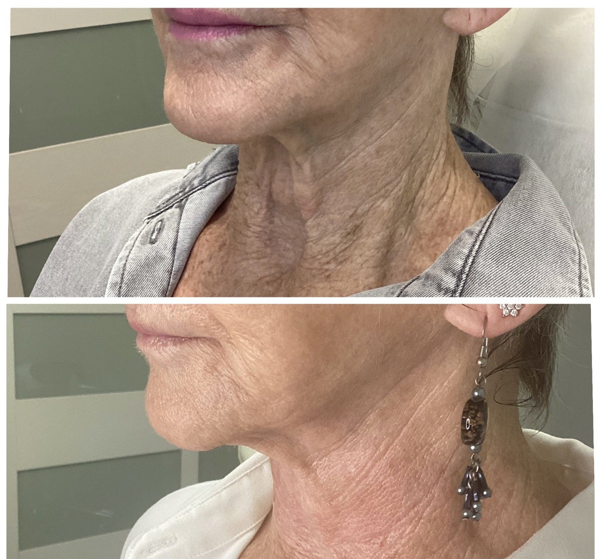 Neck lift