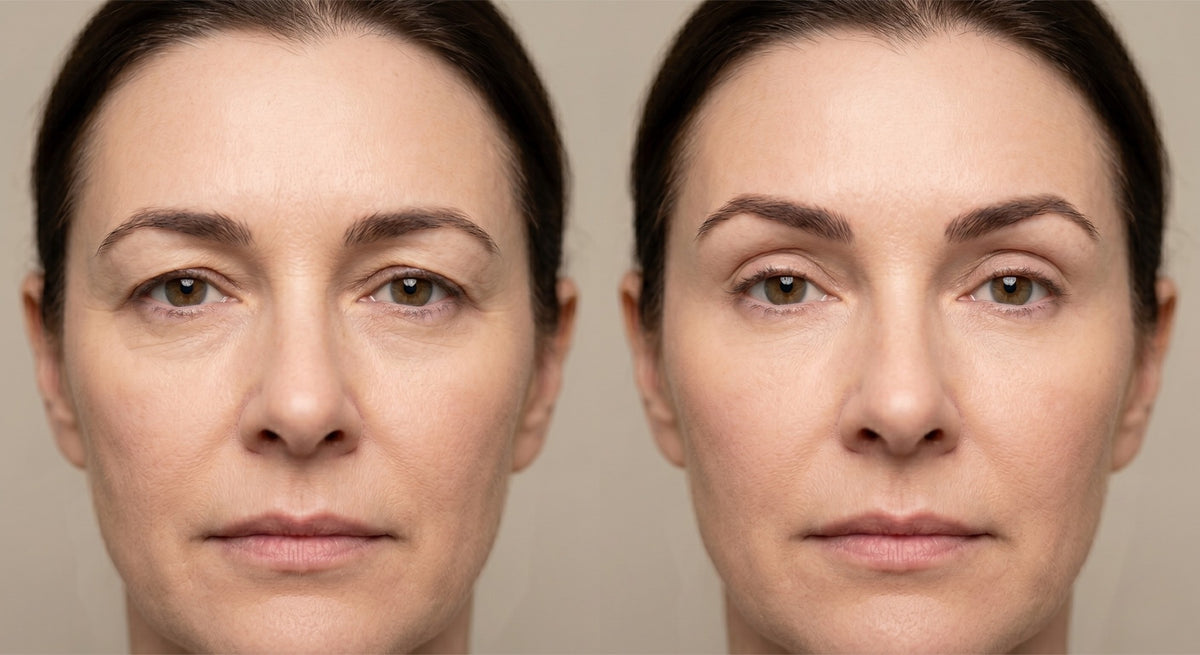 Brow lift