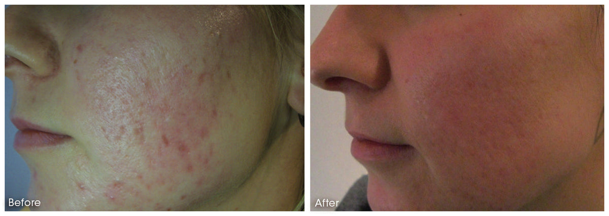 Acne scarring · 8 sessions