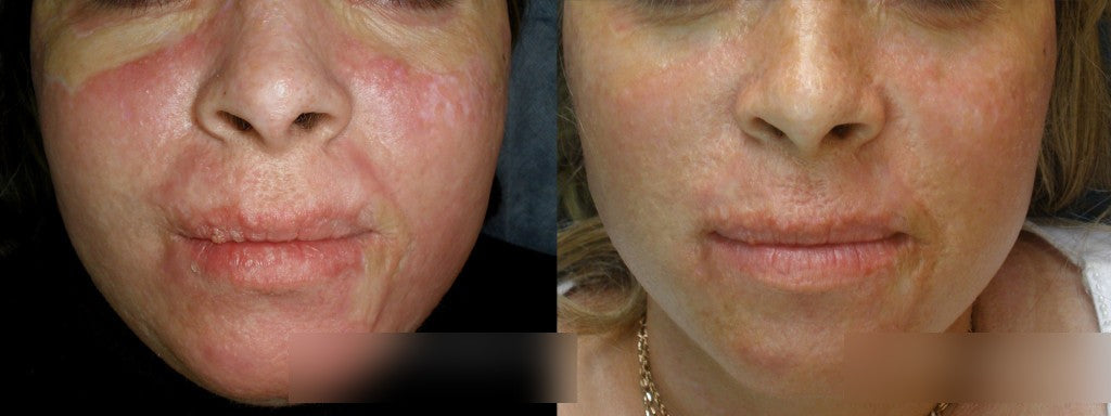 Scar revision