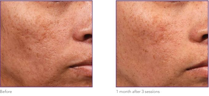 Before and after results