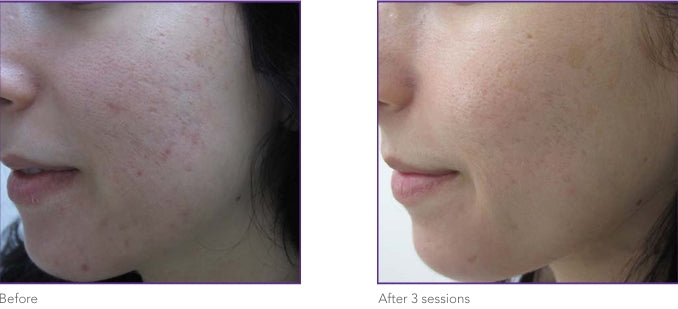 Acne and texture