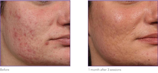Acne scars