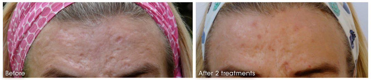 Forehead texture