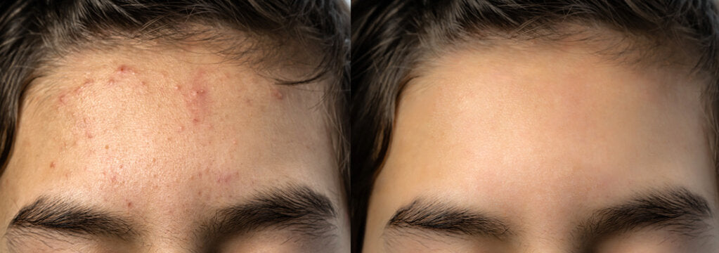 Breakouts and texture
