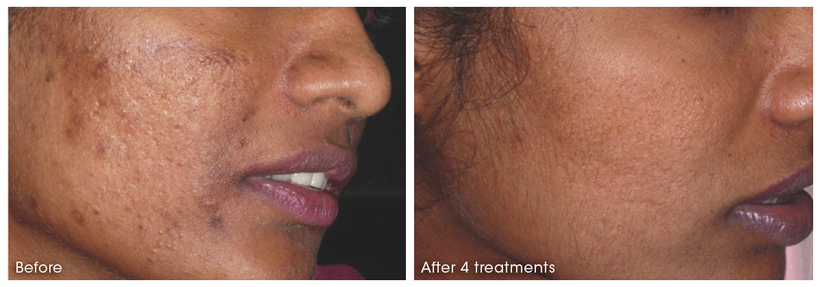 Pigmentation
