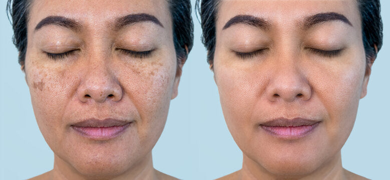 Pigmentation