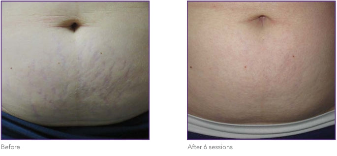 Abdominal stretch marks