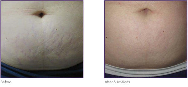 Stretch marks