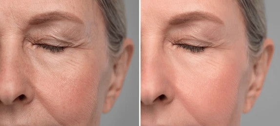 Eye-area lines