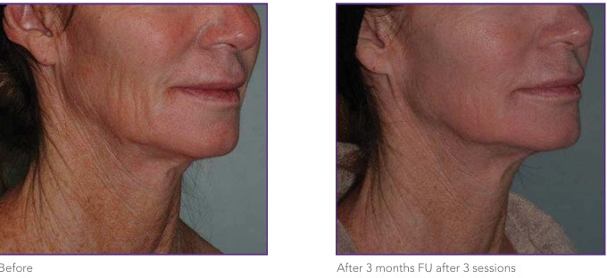 Before and after results