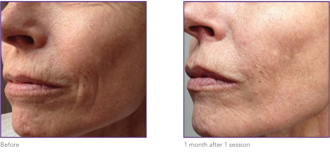 Perioral lines