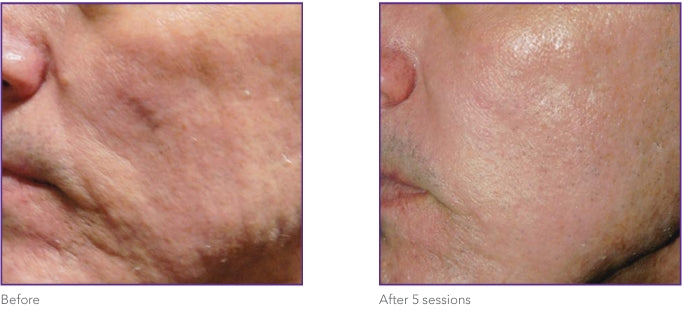 Before and after results