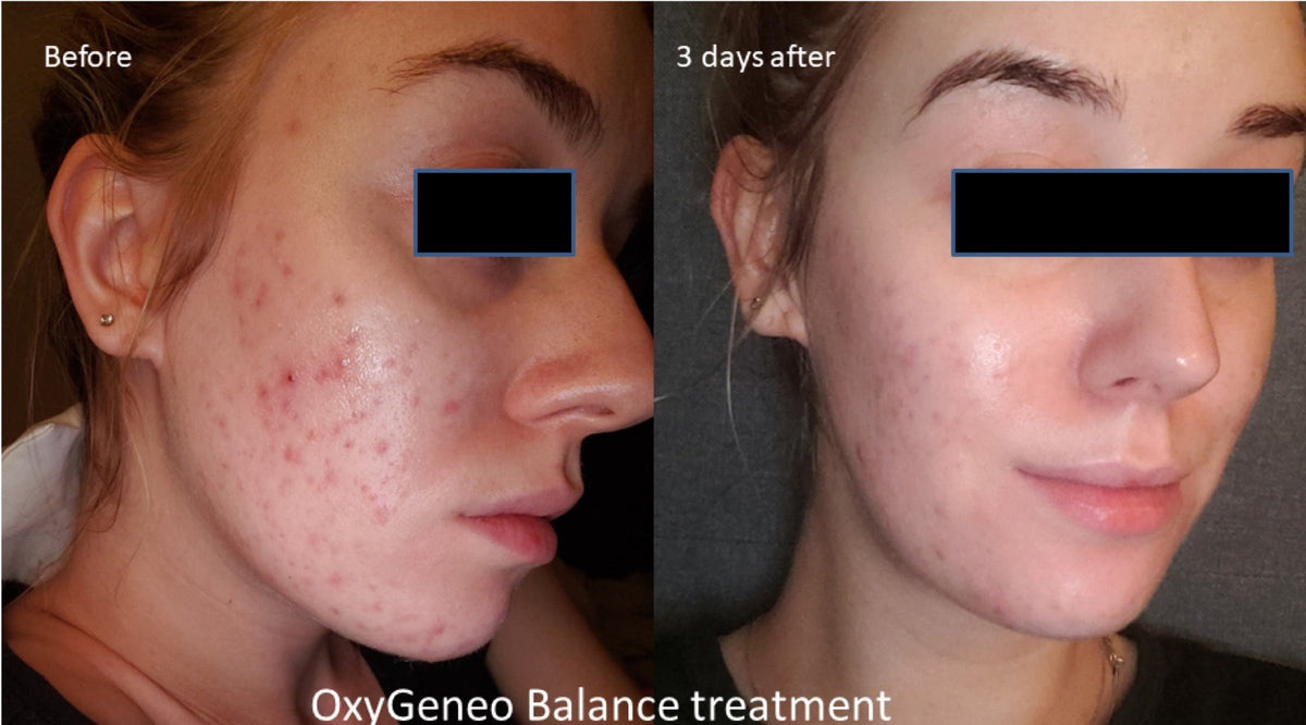 Acne / Breakouts