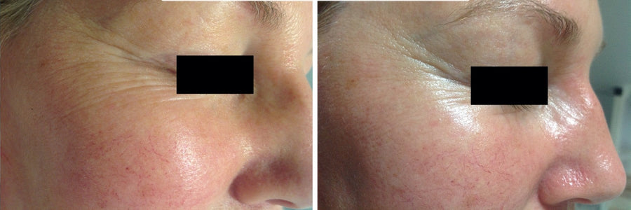 Before and after results