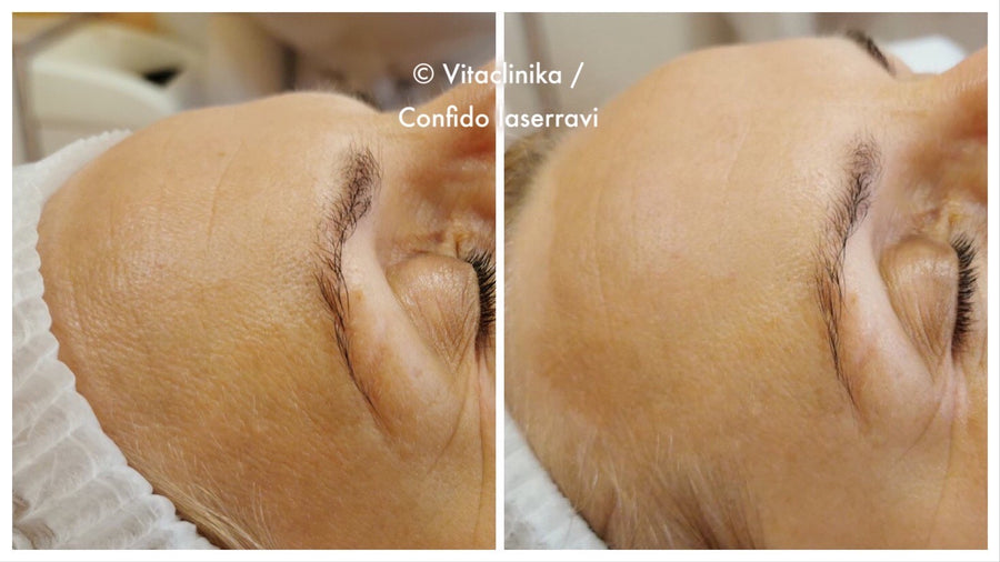Before and after results