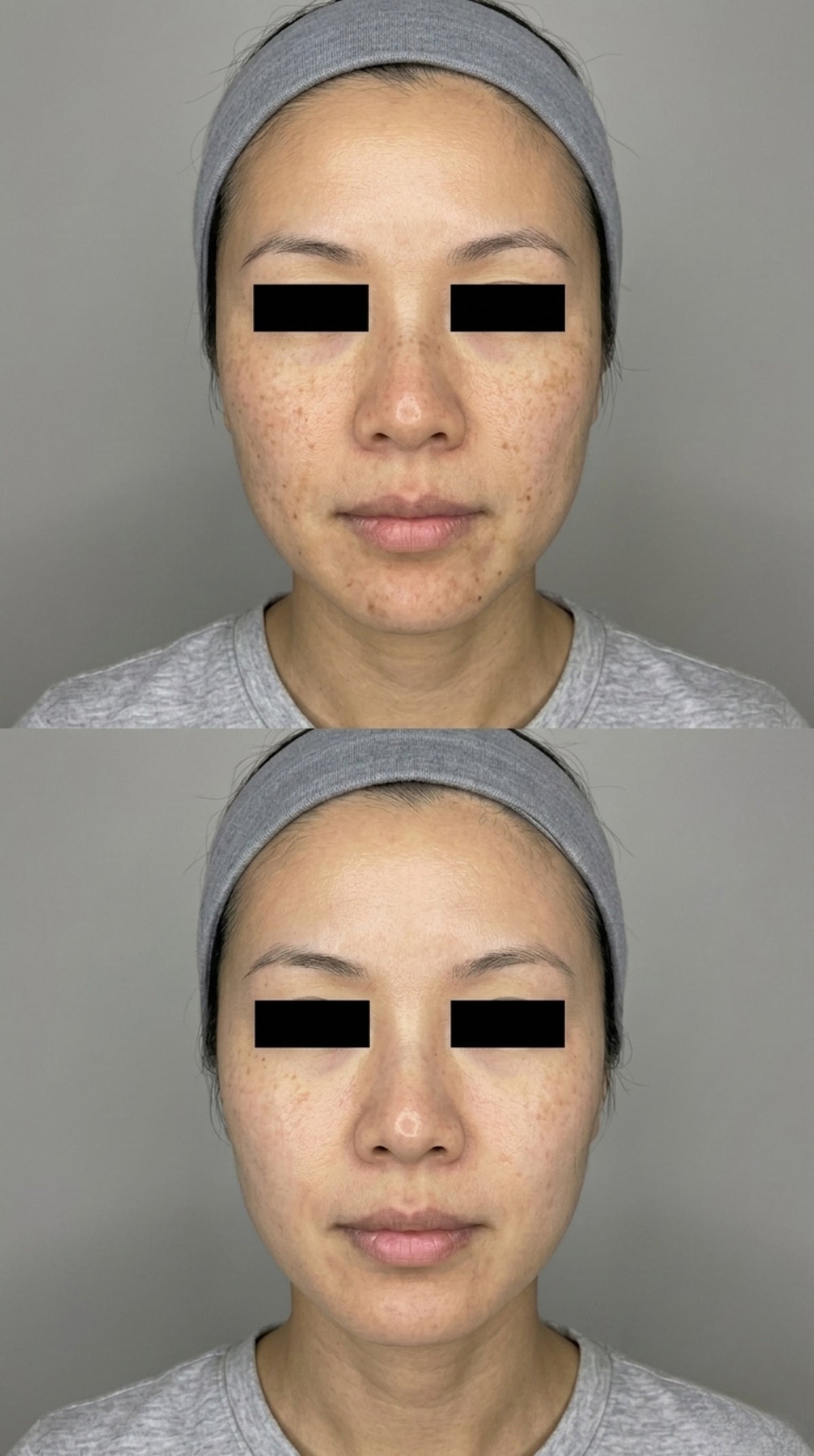 Single Treatment Results